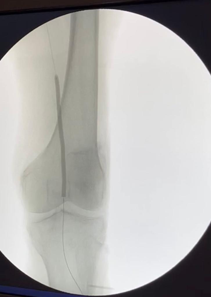 Angioplastia arterial y venosa